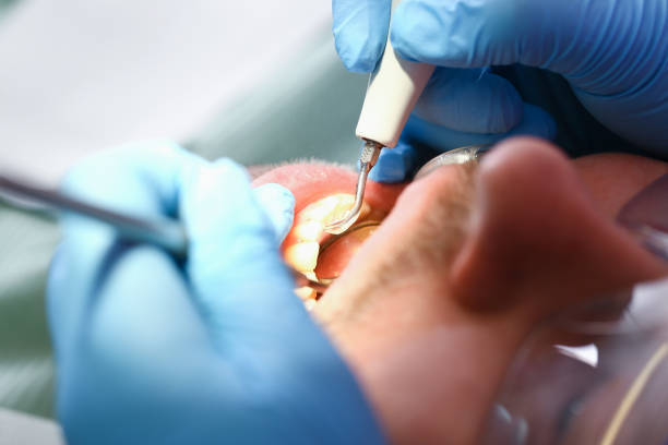 Best Emergency Root Canal Treatment in Jefferson, WI